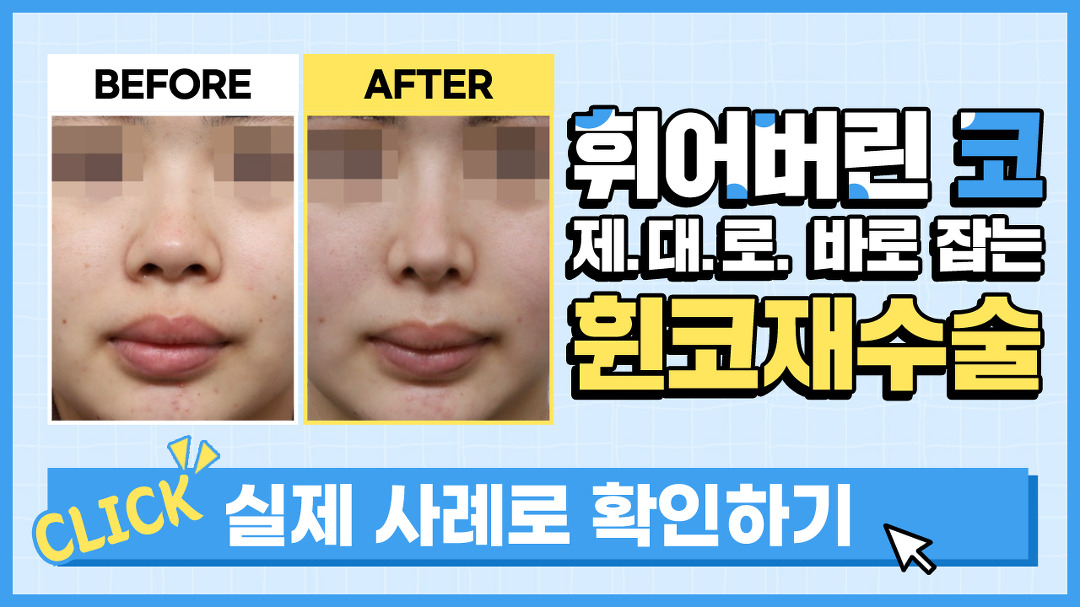 수술 후 휜코, 원인을 알면 바로 잡을 수 있다! | 휜코재수술 핵심 포인트 | AND(앤드)성형외과 - kakaoTV 수술 후 휜코... 
