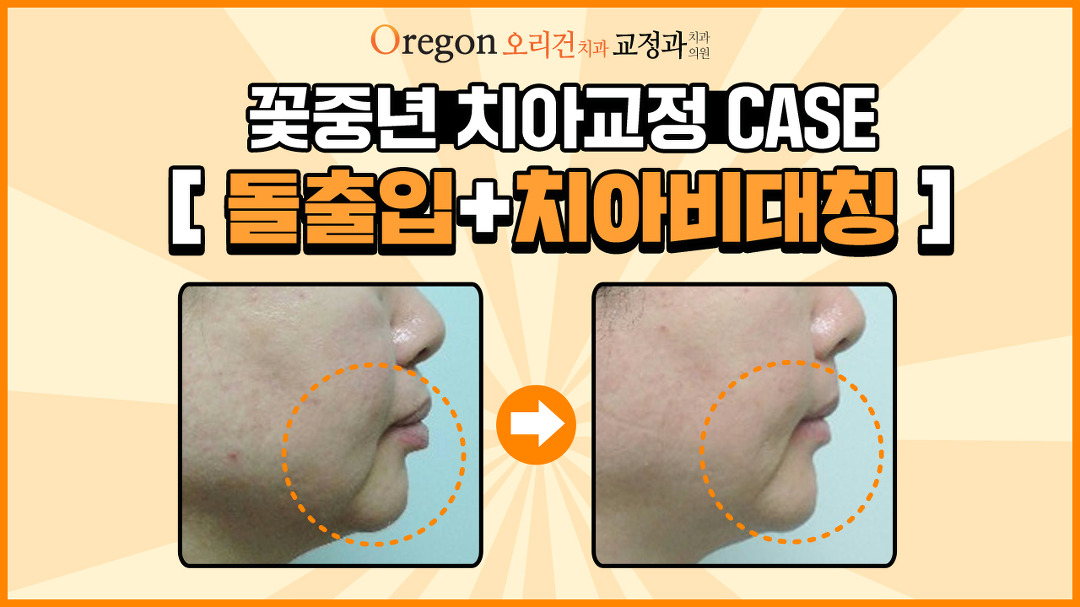 강남대치동교정치과_오리건치과】 - kakaoTV 중년치아교정... 돌출입 + 치아비대칭 교정 CASE【Feat. 강남대치동교정치과_오리건치과】