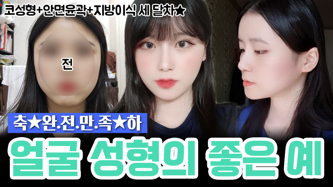 (코, 안면윤곽, 지방이식) 효과 대만족! 자연스럽게 예뻐지고 싶어? - kakaoTV (코, 안면윤곽, 지방이식) 효과 대만족! 자연스럽게 예뻐지고 싶어?