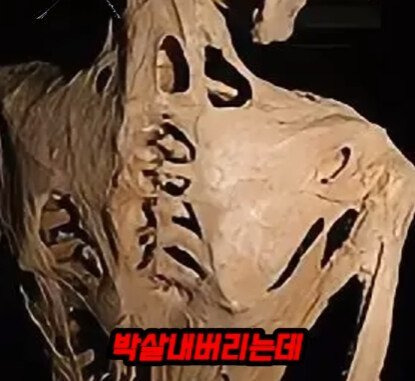 근육과 힘줄이 뼈로 변하는 질병