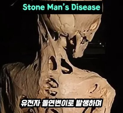 근육과 힘줄이 뼈로 변하는 질병