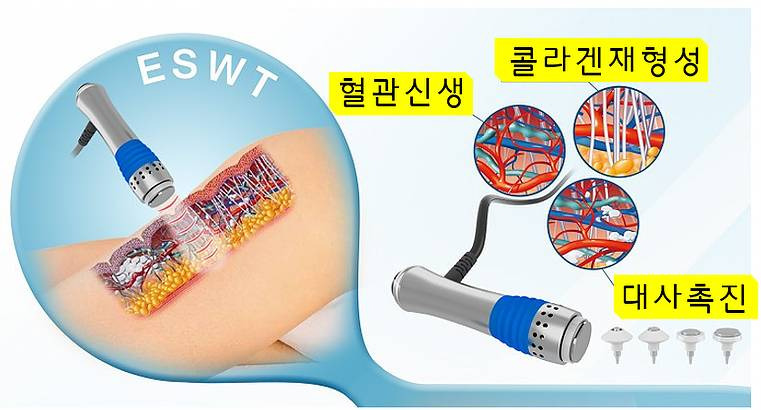 체외충격파 시술의 시작된이유