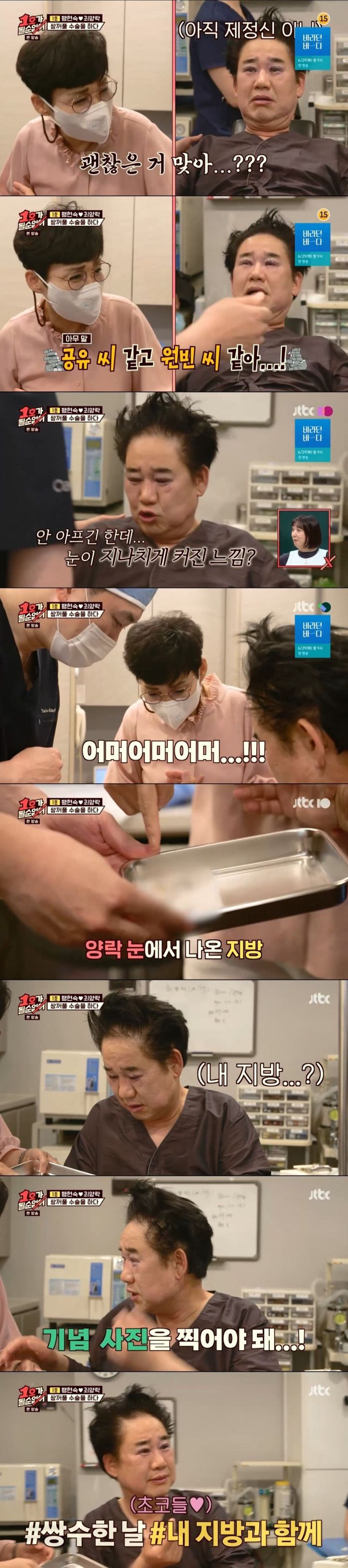 [유머] [유머]             최양락 쌍수 직후 &amp; 10일차 눈을 본 후배 개그맨들 반응. -  와이드섬