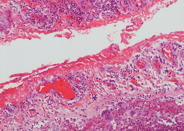 염증이 발생한 흉막세포의 전자현미경 이미지. 사진제공=Atlas of Pulmonary Pathology