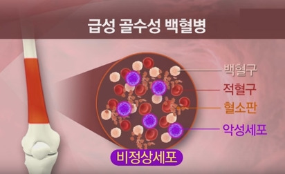 카이스트, 성골수성백혈병 등 '개인 맞춤형 암 치료' 연구 괄목한 성과