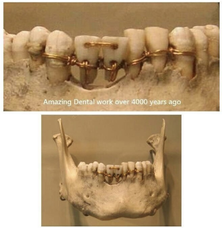 4천년전 이집트 치아 브릿지 시술