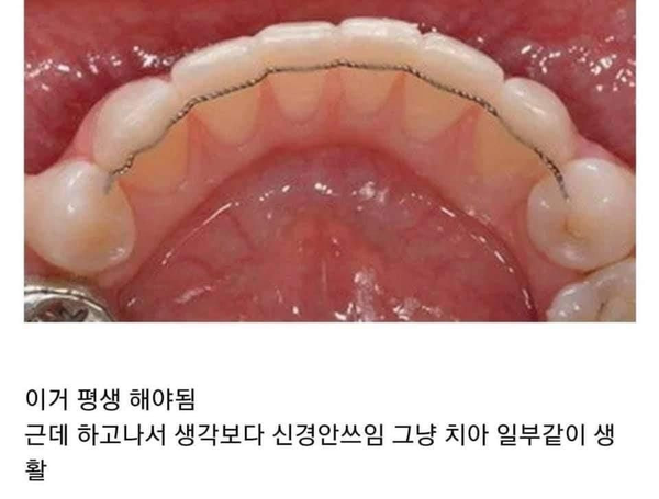 치아교정 후에 이거 모르고 하는 사람 은근 많음