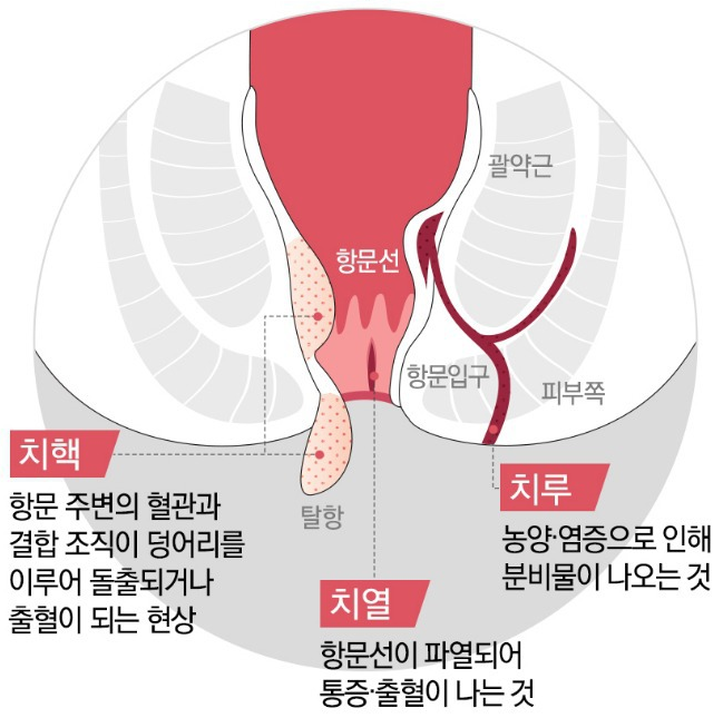 치핵 치열 치루