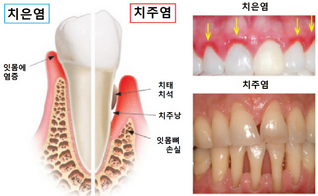 치주염 증상 및 치료법