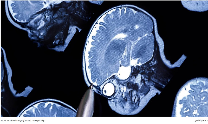 AI 시스템, MRI 사용 24개월 이하 어린이 자폐증 진단 AI system uses MRI to diagnose autism in children as young as 24 months