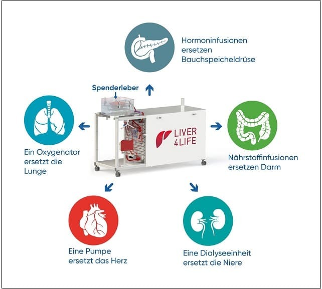 사람의 간 세계 최초 체외 보관 이식 성공 A world first: for the first time, a human liver was treated in a machine ...