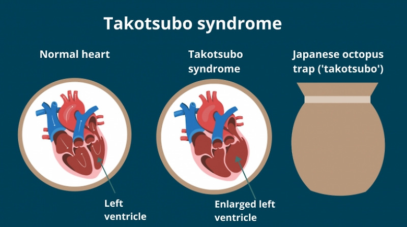 코로나19 백신, 타코츠보 심근병증 유발 VIDEO:Research: COVID-19 Vaccines May Trigger Takotsubo Cardiomyopathy