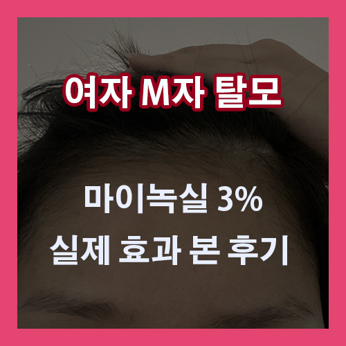 [여자 M자 탈모치료] 마이녹실 3% 효과 본 후기 (내돈내산, 미녹시딜)