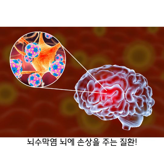 뇌수막염 원인과 증상 그리고 치료방법과 예방