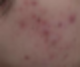 OurBody 여드름 기본정보::정의 원인 종류 화이트헤드 블랙헤드 염증성 낭종 결절성 켈로이드성...acne vulgaris