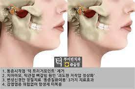[귀 통증 치료] 어금니 꽉 깨물기로 인한 통증 치료 방법