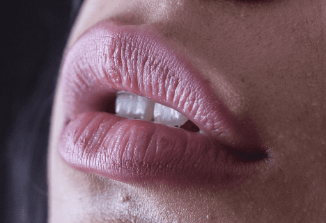 입술 각질의 원인과 입술 각질을 제거하는 방법