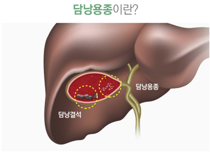 쓸개(담낭) 제거수술 후유증, 12개월 후 리뷰
