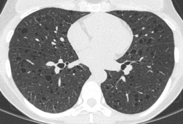 폐의 특이증상, 낭종성 폐질환(Cystic Lung Disease) : 낭종성 폐질환 증상, 기침, 호흡곤란 등