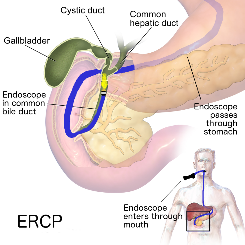 내시경역행담췌관조영술(ERCP) 검사목적과 참고사항에 대한 정보