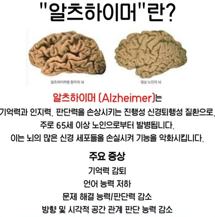 뇌질환 '알츠하이머'에 대한 모든것!