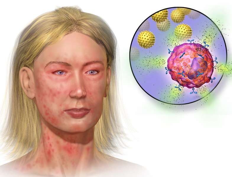아나필락시스: 생명을 위협하는 알레르기 반응