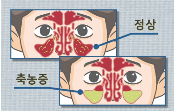 약 먹어도 안 낫는 축농증...완치율 높이는 치료 방법은