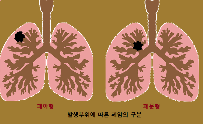 폐암은 왜 생기는가? 폐암 종류 알아보기. 폐암 증상 알아보기.