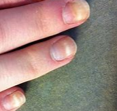 손발톱 들뜨거나 분리되는 조갑박리증 원인, 증상, 치료법