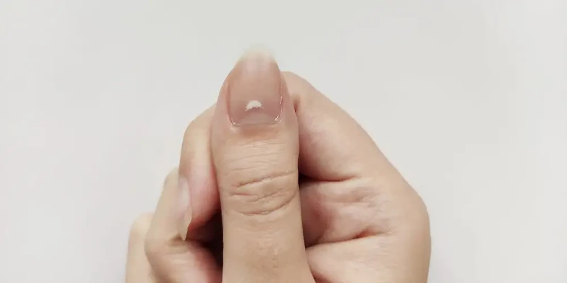 손톱에 나타나는 흰 반점 무엇일까?