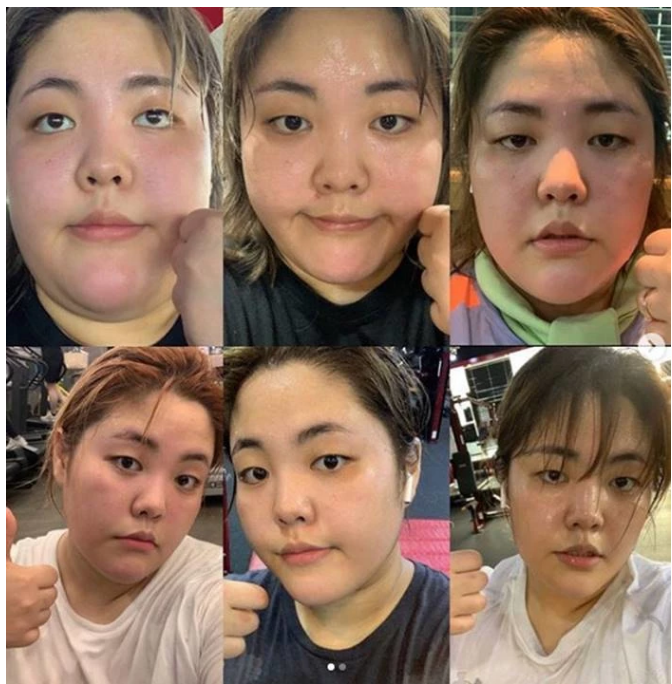 대형 유튜버 다이어터 양수빈 '가슴 성형수술' 솔직 후기