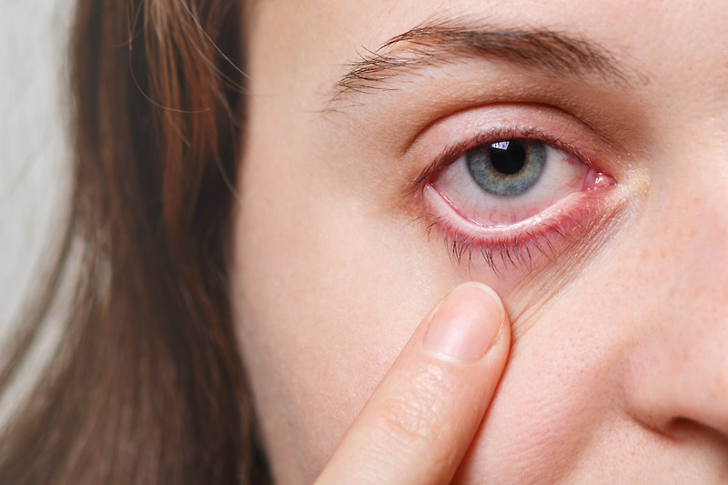 눈 충혈 원인과 눈 건강 생활 습관 알고 계세요?