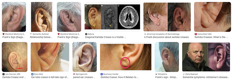 귀주름과 치매는 어떤 관련이 있을까요?
