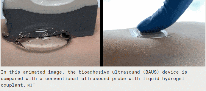 몸 속을 들여다보는 우표크기 초음파 스티커 VIDEO: Ultrasound Stickers Look Inside the Body