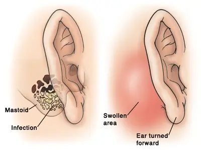 어금니 꽉 깨물면 귀 아픈 이유: 유양돌기염과의 관계 밝혀보기