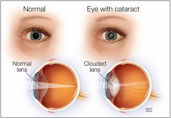 백내장, 수술 안하고 약물로 치료한다 Experts say vision-robbing condition may soon be treated with DRUGS