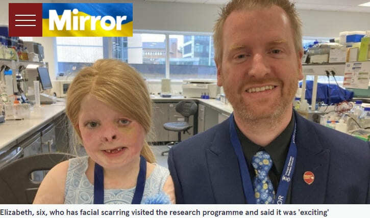 3D 프린팅 귀를 갖게 된 소녀  Girl injured by fire could be among world’s first patients to get 3D-printed ears