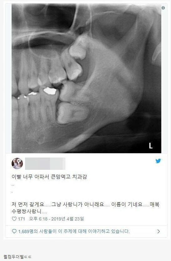 (치과) 매복수평쌍사랑니