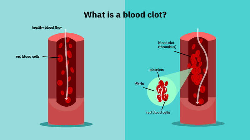 혈전(혈액 응고 Blood clot) 증상 Blood clots: five reasons they may happen