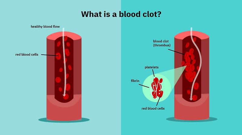 혈전(혈액 응고 Blood clot) 증상 Blood clots: five reasons they may happen