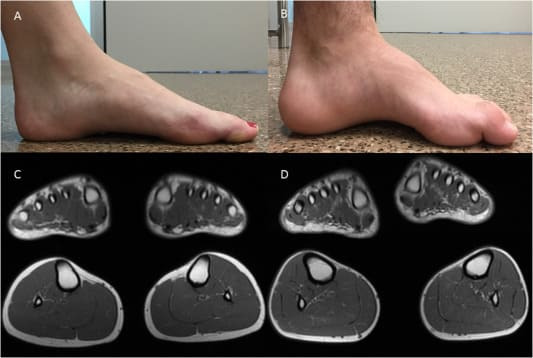 대구경북과학기술원, 세계 최초 샤르코-마리-투스(CMT) 치료법 개발 Scientists develop world's first Charcot-Marie-Tooth therapy