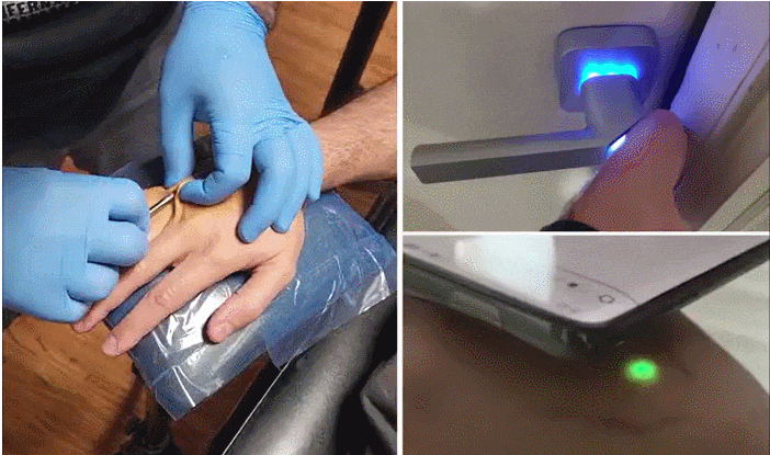 피부에 칩 이식한 테슬라 소유자 왜  VIDEO: Man implants tiny contactless Tesla key chip into his hand