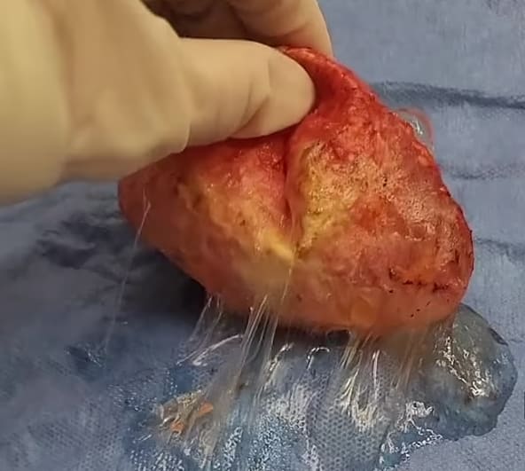 이런! 성형 시술 의사가 10년 후 고객의 유방 보형물을 꺼냈더니..VIDEO: TikTok surgeon removes woman's 35-year-old breast implants