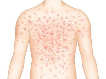 홍역(Measles)