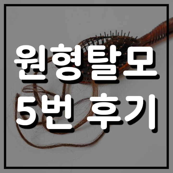 원형탈모 완치 기간 & 방법 (5번의 치료 후기)