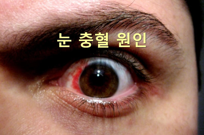 눈 실핏줄 터지는 이유와 눈 충혈 원인