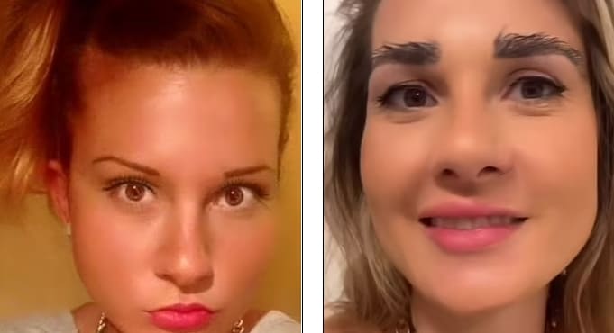 자신의 머리 털로 눈썹 이식한 여성...어머! 숯덩이네! VIDEO:Cotswolds woman undergoes eyebrow transplant using hairs from head