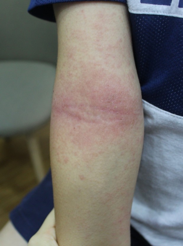 아토피 피부염의 직접적인 원인은 황색포도상구균  : 아토피 피부염