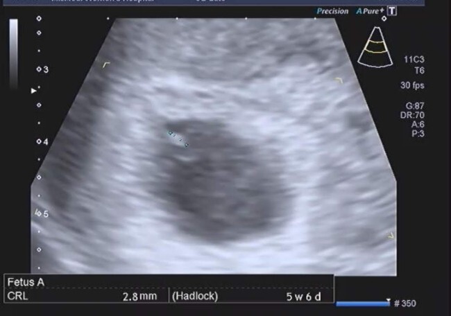 [둘째/임신/임산부] 임신초기 초음파 (오른쪽 아랫배 통증/자궁근종?)