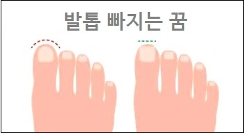 발톱 빠지는 꿈 깨지는 꿈 발톱을 자르는 꿈 발톱이 자란꿈 발톱 뽑히는 꿈 해몽